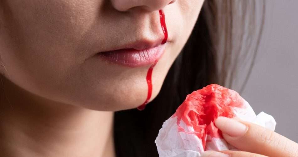 krwawienie z nosa